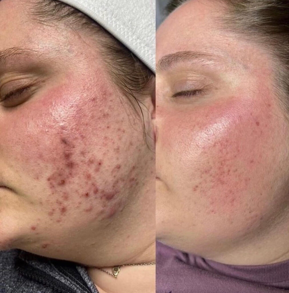 Acne before and after