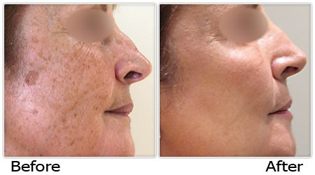 Age spot 2 before and after