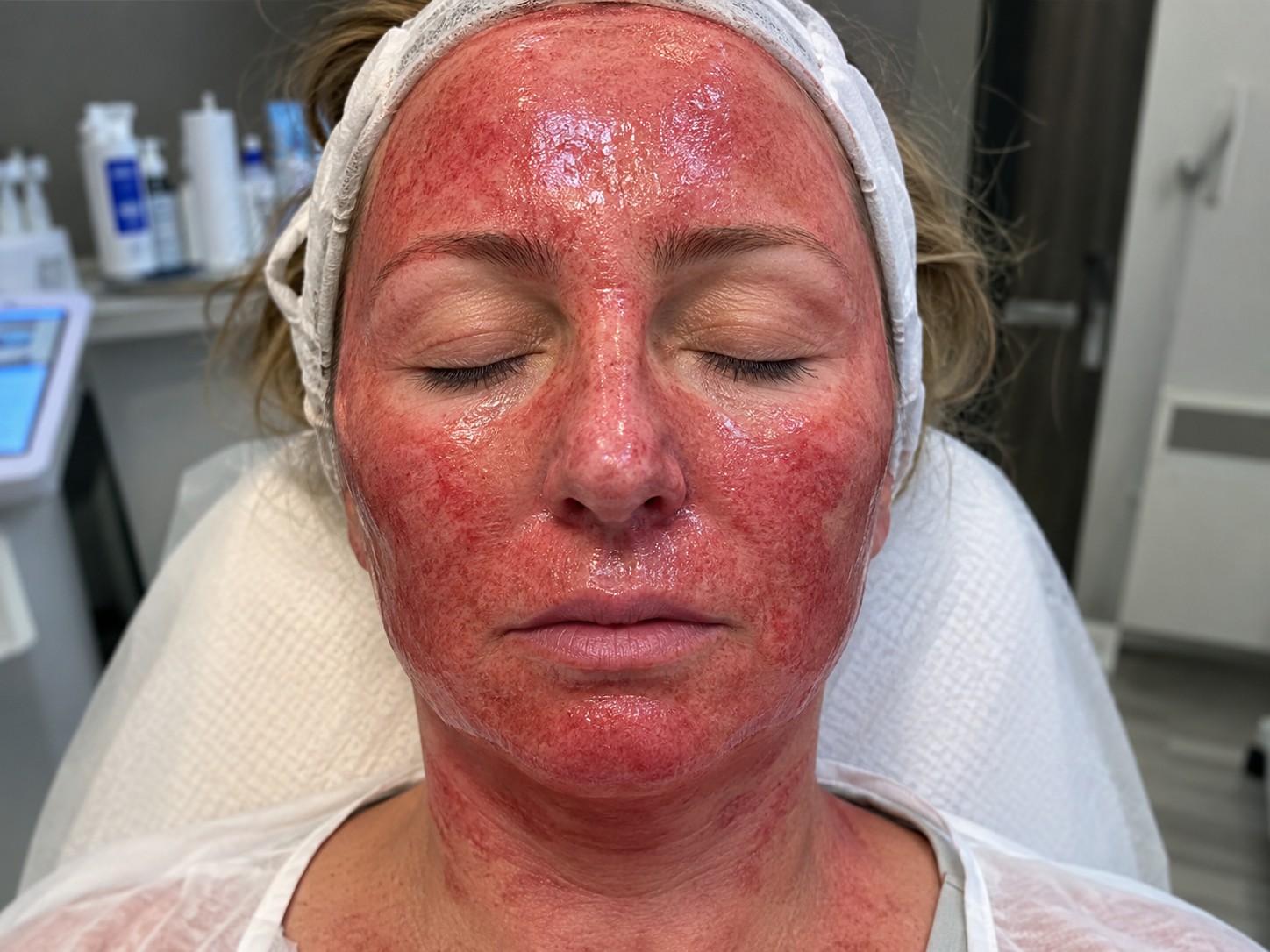 Facial Ablation