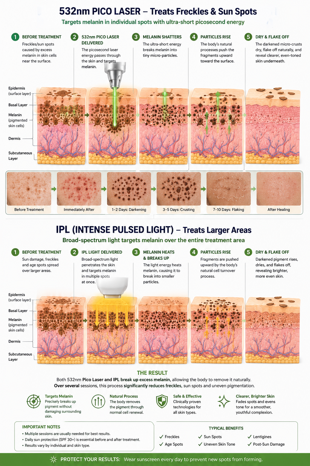 Pico and IPL clearing freckles and spots
